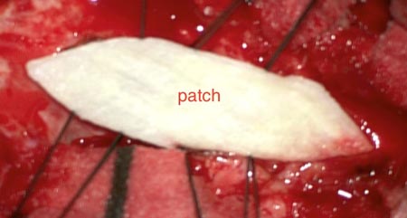 To enlarge the dura, a patch of connective tissue material is used.