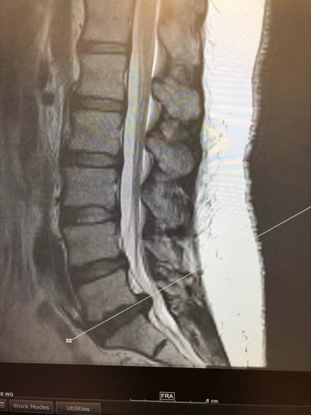 MRI of lumbar spine (sagittal view) showing large L5-S1 disc herniation.
