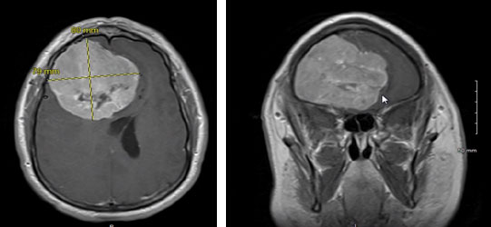 Meningioma causing compression and shifting of both frontal lobes 