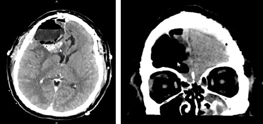Post-operative CT imaging shows complete resection of the tumor 