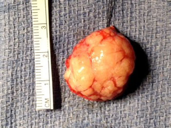 Photograph of a very small meningioma  