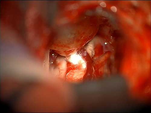 Microsurgical placement of Teflon felt between the blood vessels and the left trigeminal nerve